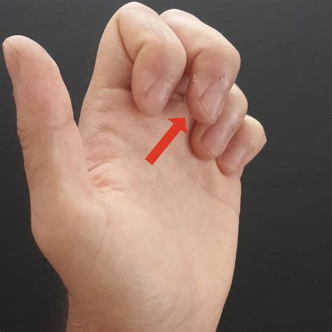 parmak eklemleri nasıl tedavi edilir